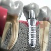 имплантации зубов